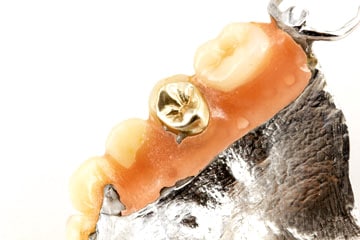 Zahn Goldfüllung